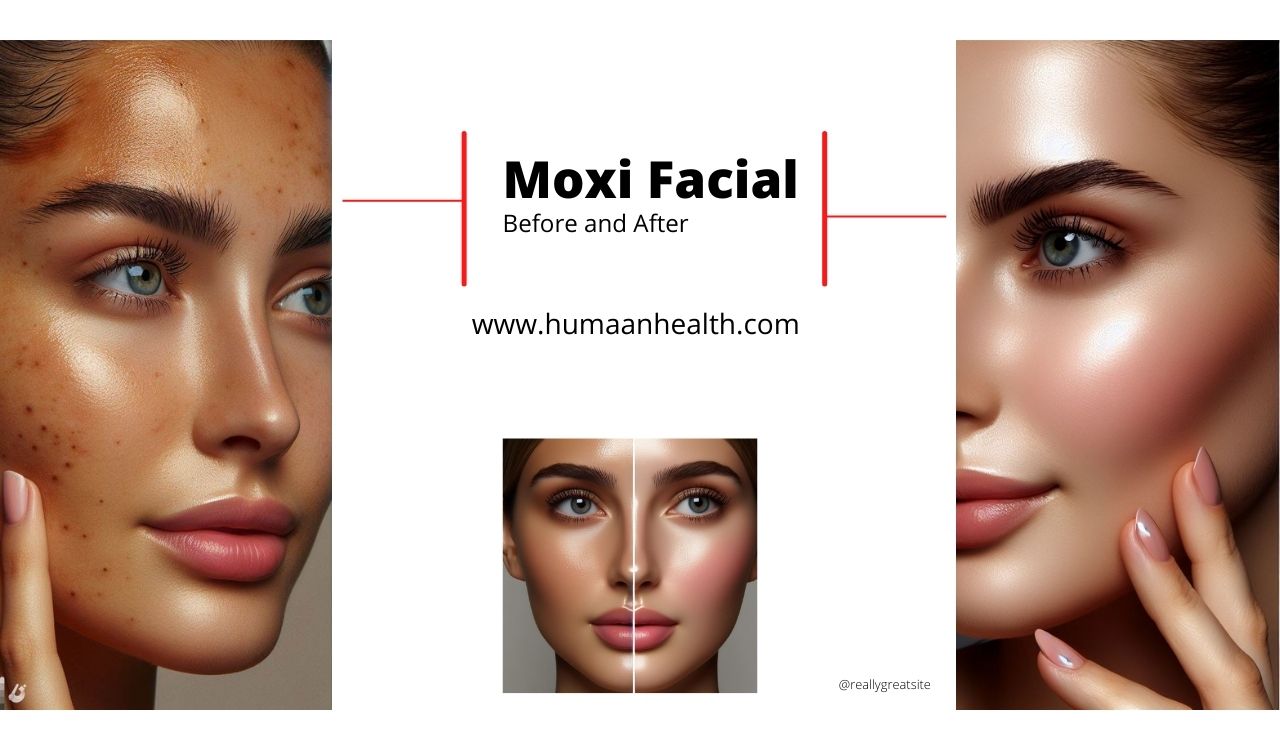 moxi facial treatment