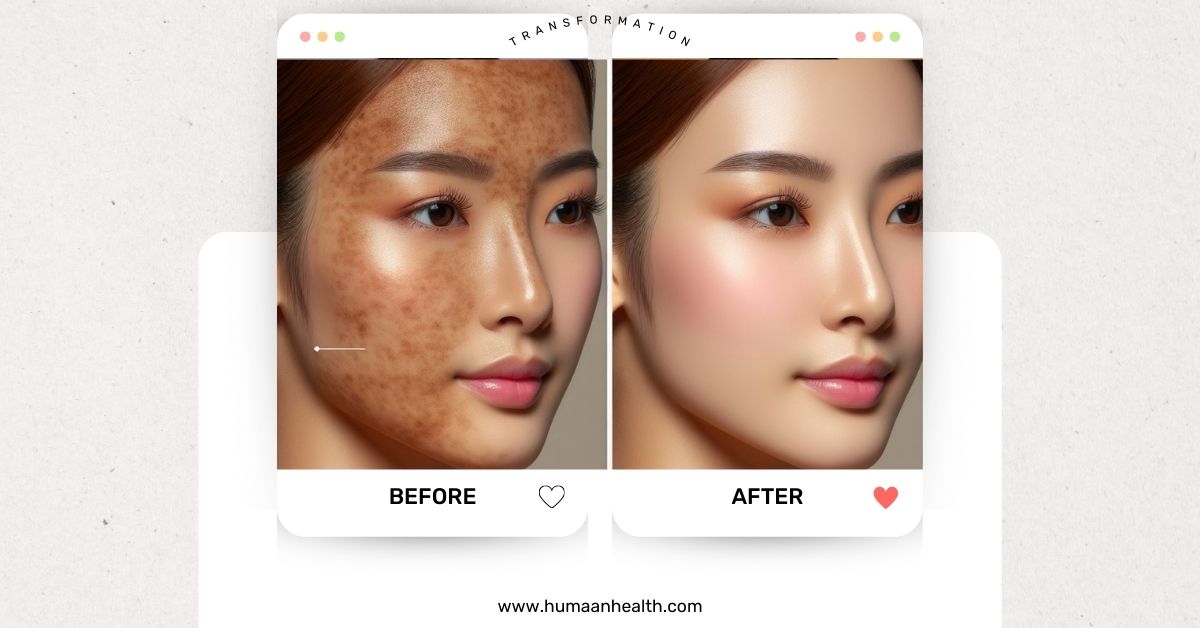 Moxi facial