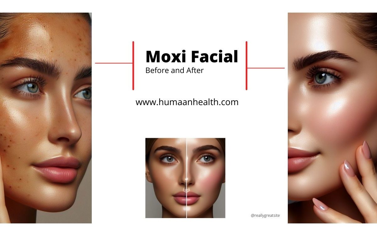 moxi facial treatment