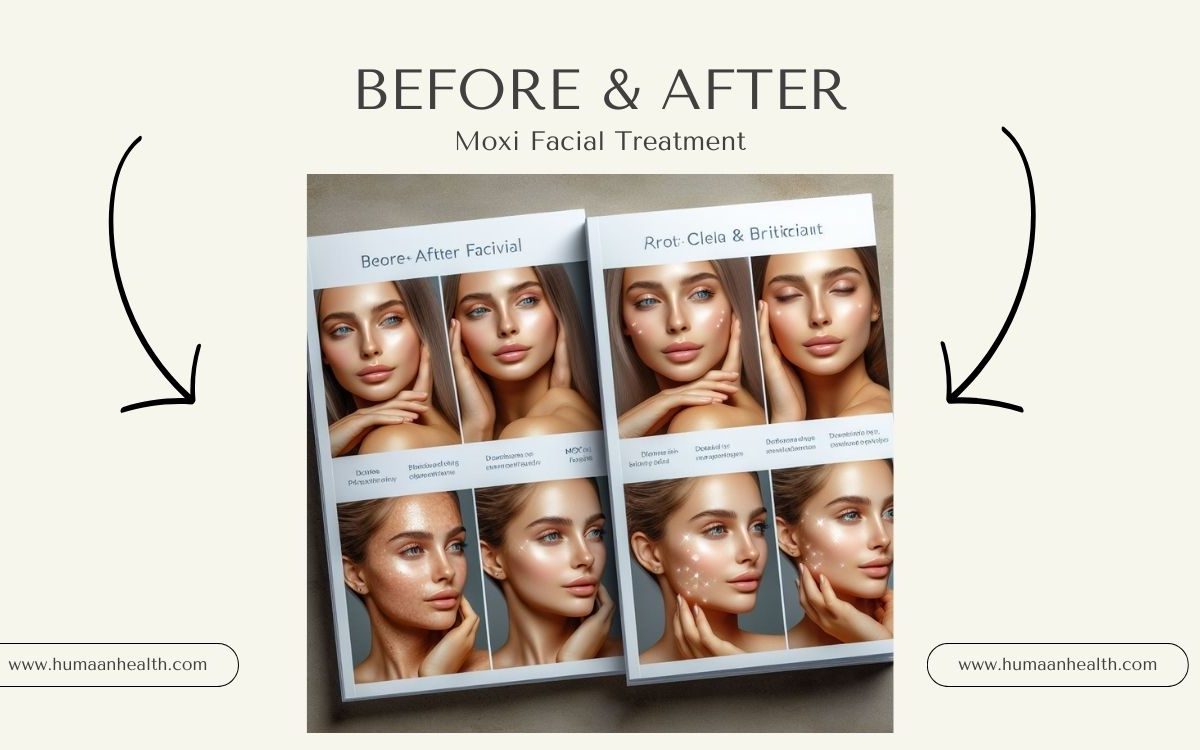 Moxi Facial Treatment Before and After: A Comprehensive Transformation